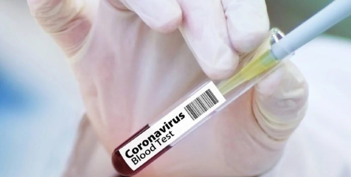 COVID-19 Test Analizini 30 Kat Hizlandiran Yapay Zeka Yazilimi